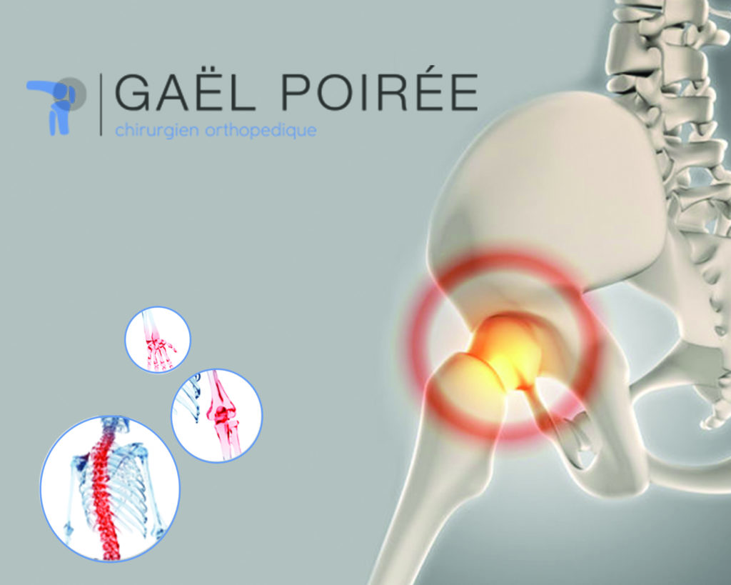 Dr Gaël Poirée — Chirurgie orthopédique